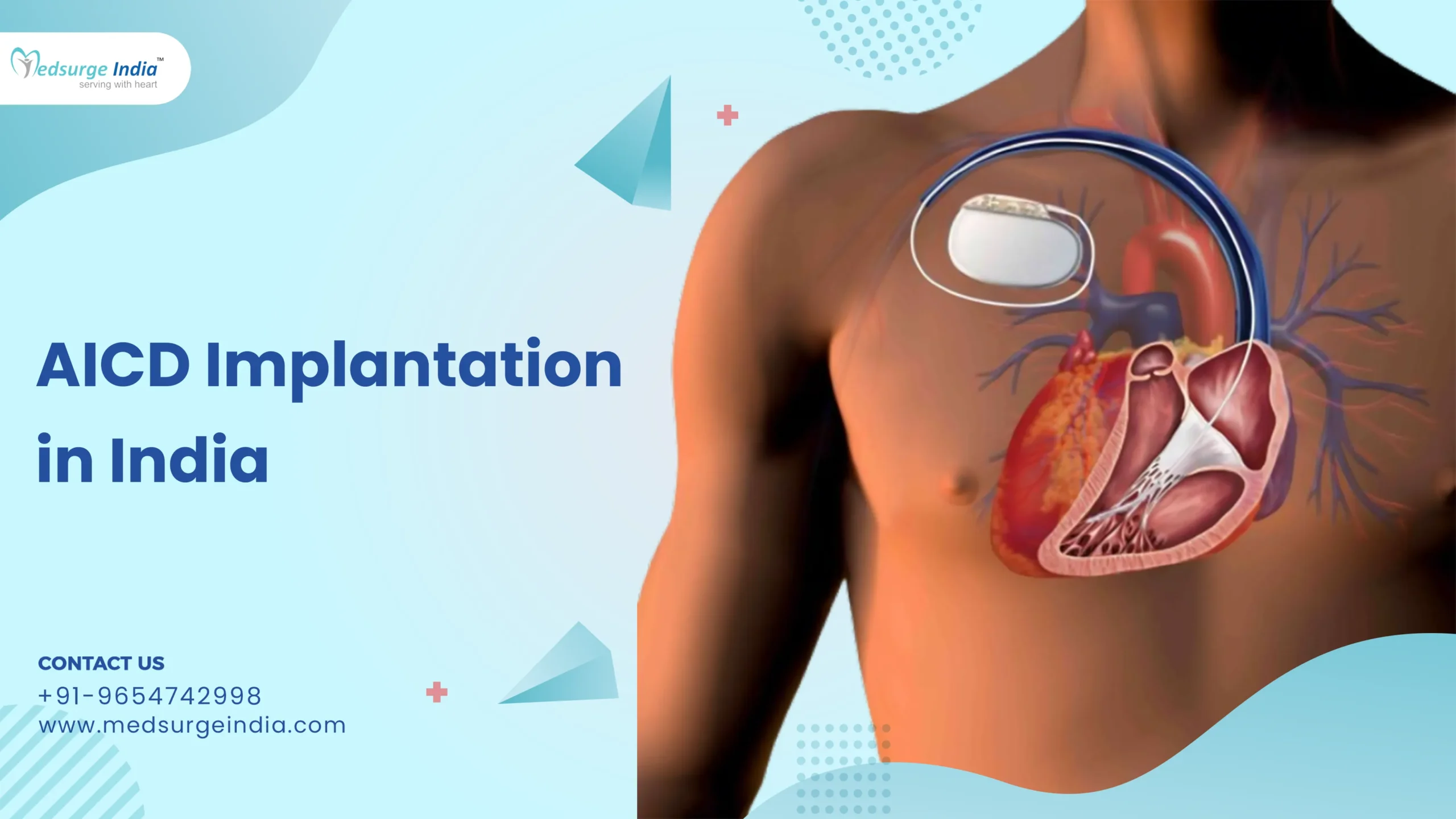 AICD Implantation Cost in India