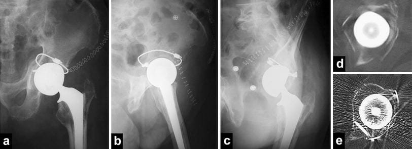 Acetabular Fixation cost in india