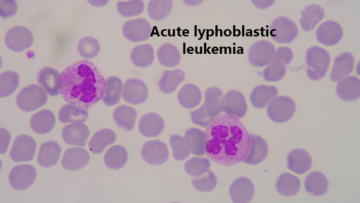 acute-lymphocytic-leukemia-treatment-cost-in-india-medsurgeindia