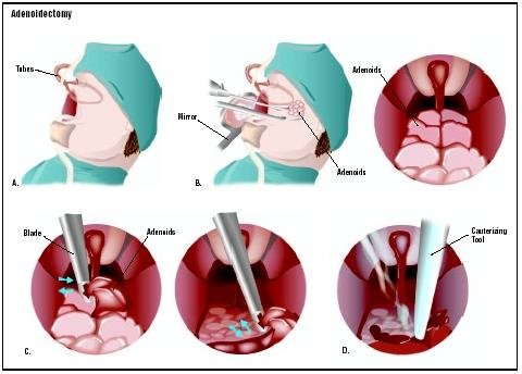 Adenoidectomy Treatment in india