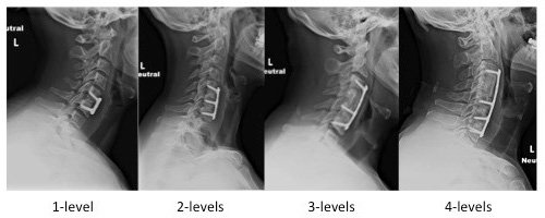 Anterior Cervical Discectomy Cost in India