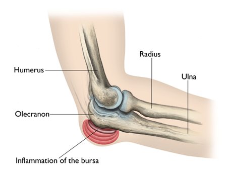 Elbow Replacement surgery Cost In India
