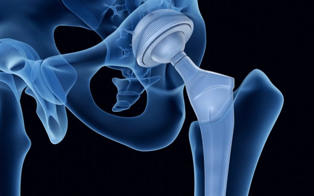Total Hip Replacement Surgery Procedure & Causes in Kochi