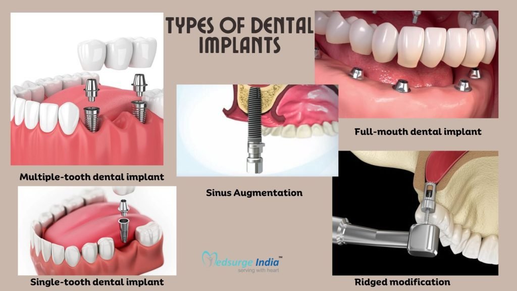 Types of Dental Implant Procedures