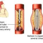 Balloon Angioplasty Cost in India