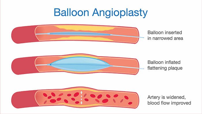 Balloon Angioplasty Cost in India