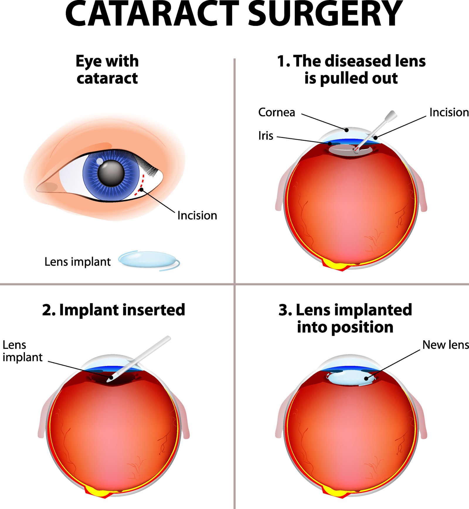 How Long For Laser Cataract Surgery To Heal