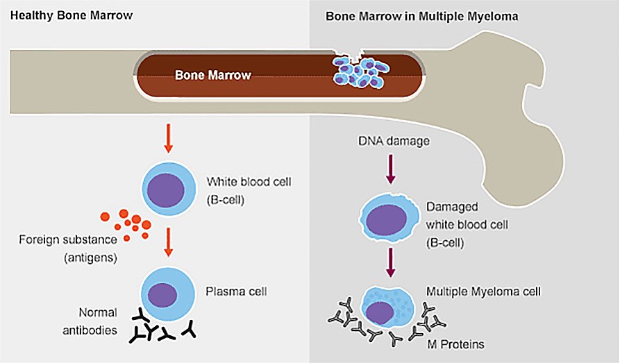 Multiple Mylemo Treatment | Multiple Myeloma Treatment ...