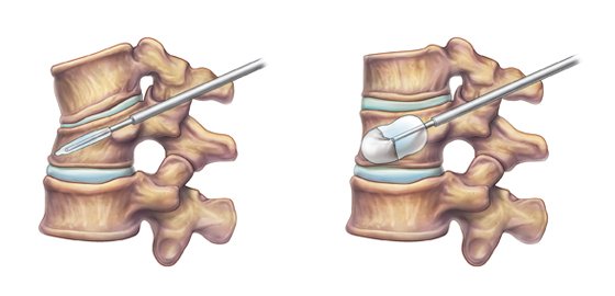 vertebroplasty and kyphoplasty cost in india