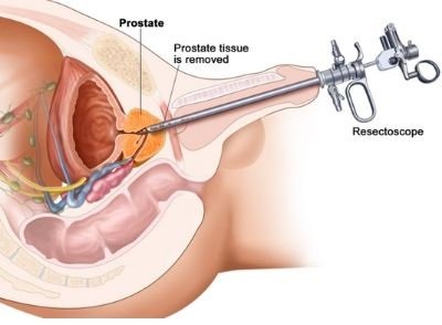 prostate cancer operation cost in india