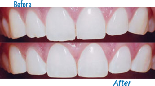 tooth reshaping and dental contouring cost in india
