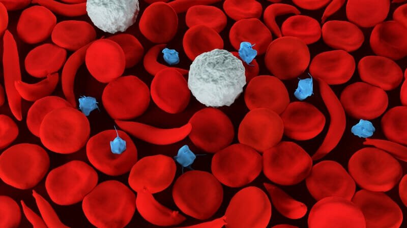 Best Treatment For Sickle Cell Anemia