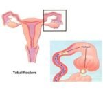 Blocked Fallopian Tube Treatment Cost in India