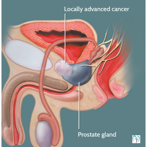Prostate Cancer Causes, Symptoms & Treatment