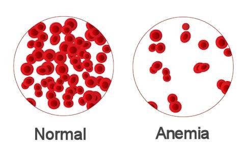  ANEMIA CELL