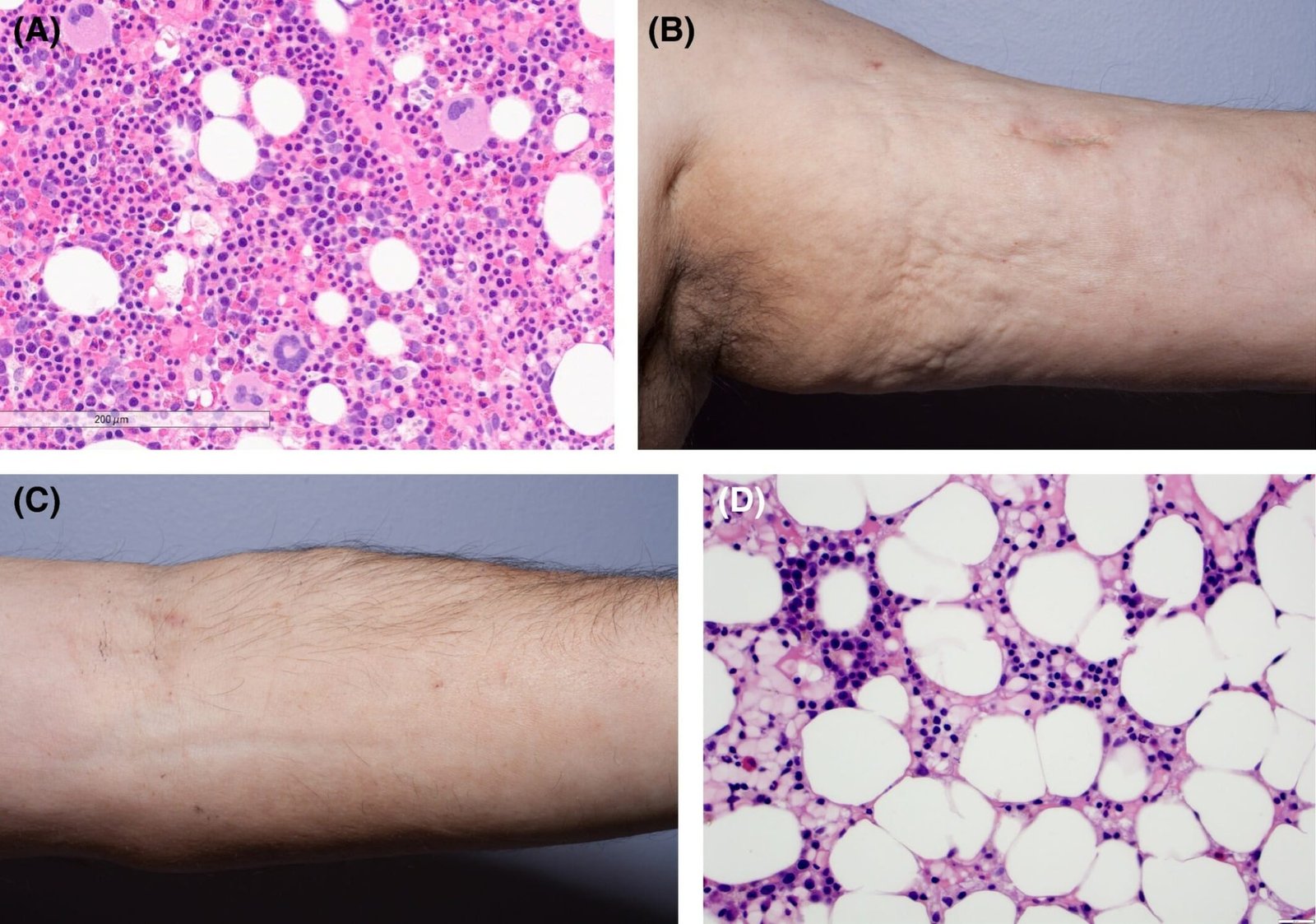 all-you-must-know-about-aplastic-anemia-medsurge-india