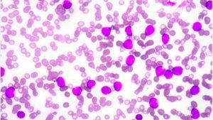 Aplastic Anemia Treatment in India