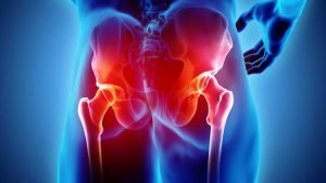What is Hip Preservation and What Are its Benefits? Hip Preservation in India