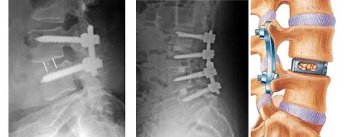 Spinal Fusion surgery 