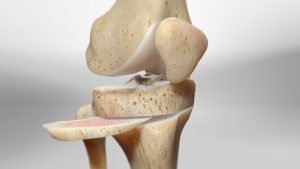 Osteotomy Surgery In India