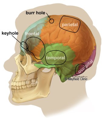 know about craniotomy