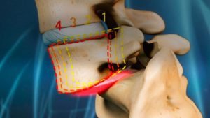 Spinal Fusion Surgery in India