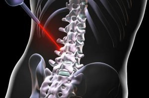 laser spinal surgery