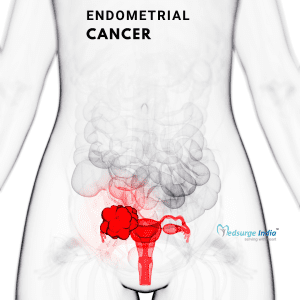Endometrial Cancer Treatment in India
