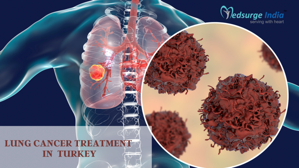 Lung Cancer Treatment Cost in Turkey Lung Cancer Treatment