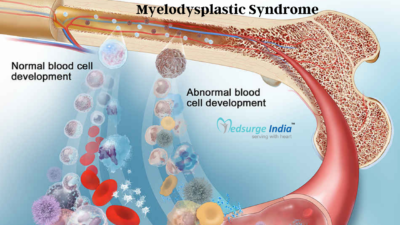 Know All About Myelodysplastic Syndrome and Its Treatment in India