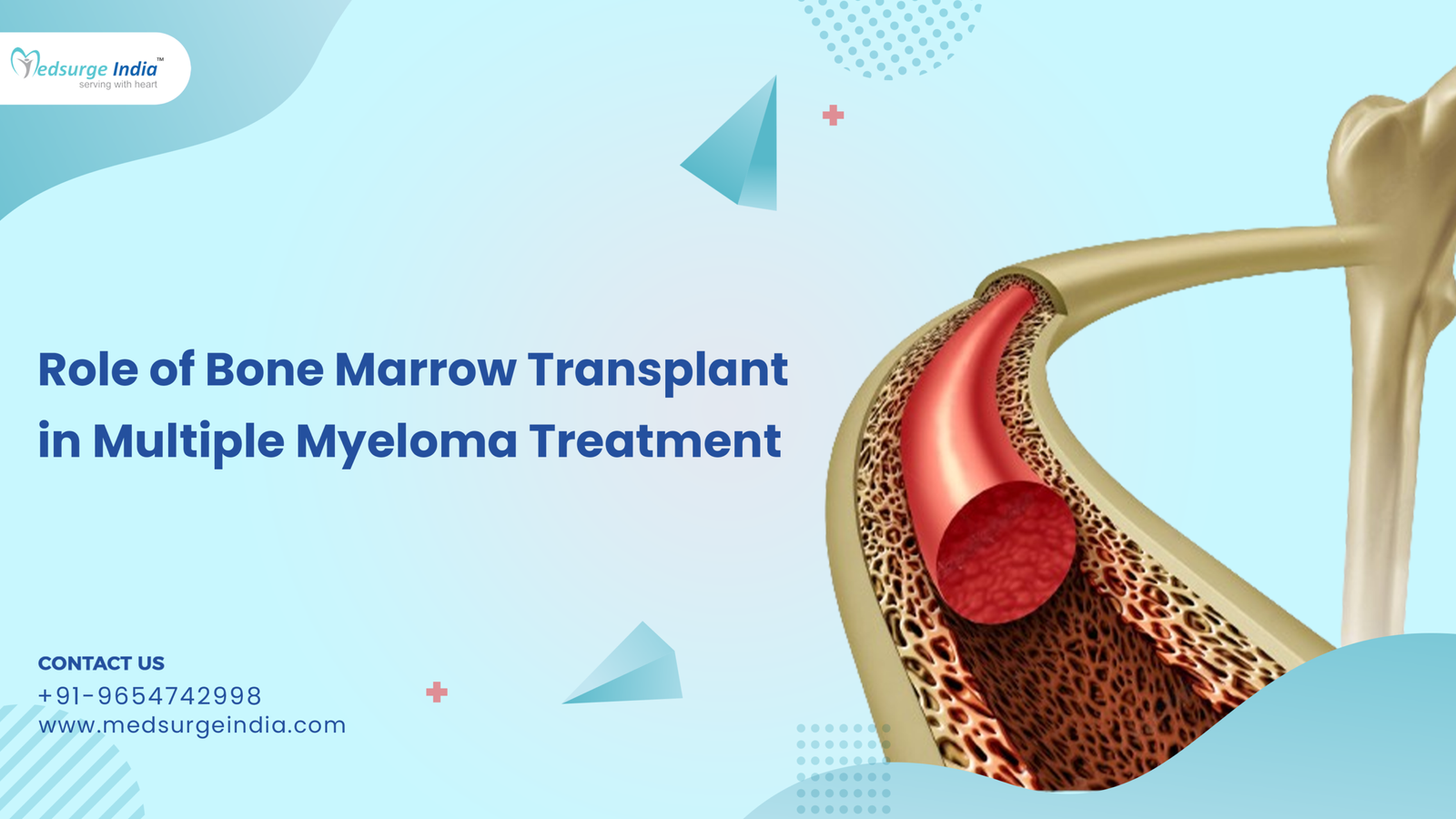 Role of Bone Marrow Transplant in Multiple Myeloma Treatment