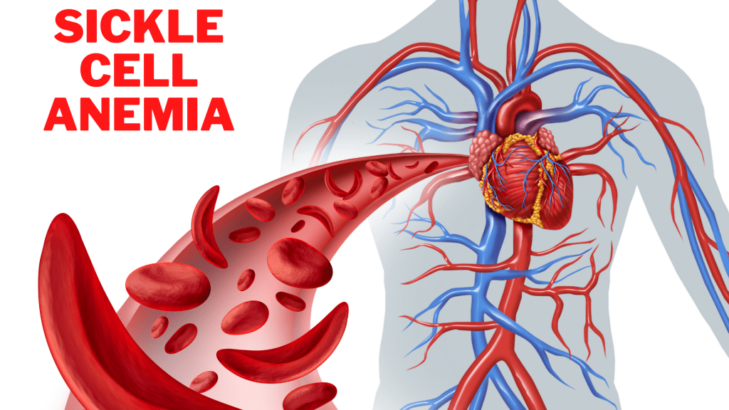 How Is Sickle Cell Anemia Diagnosed