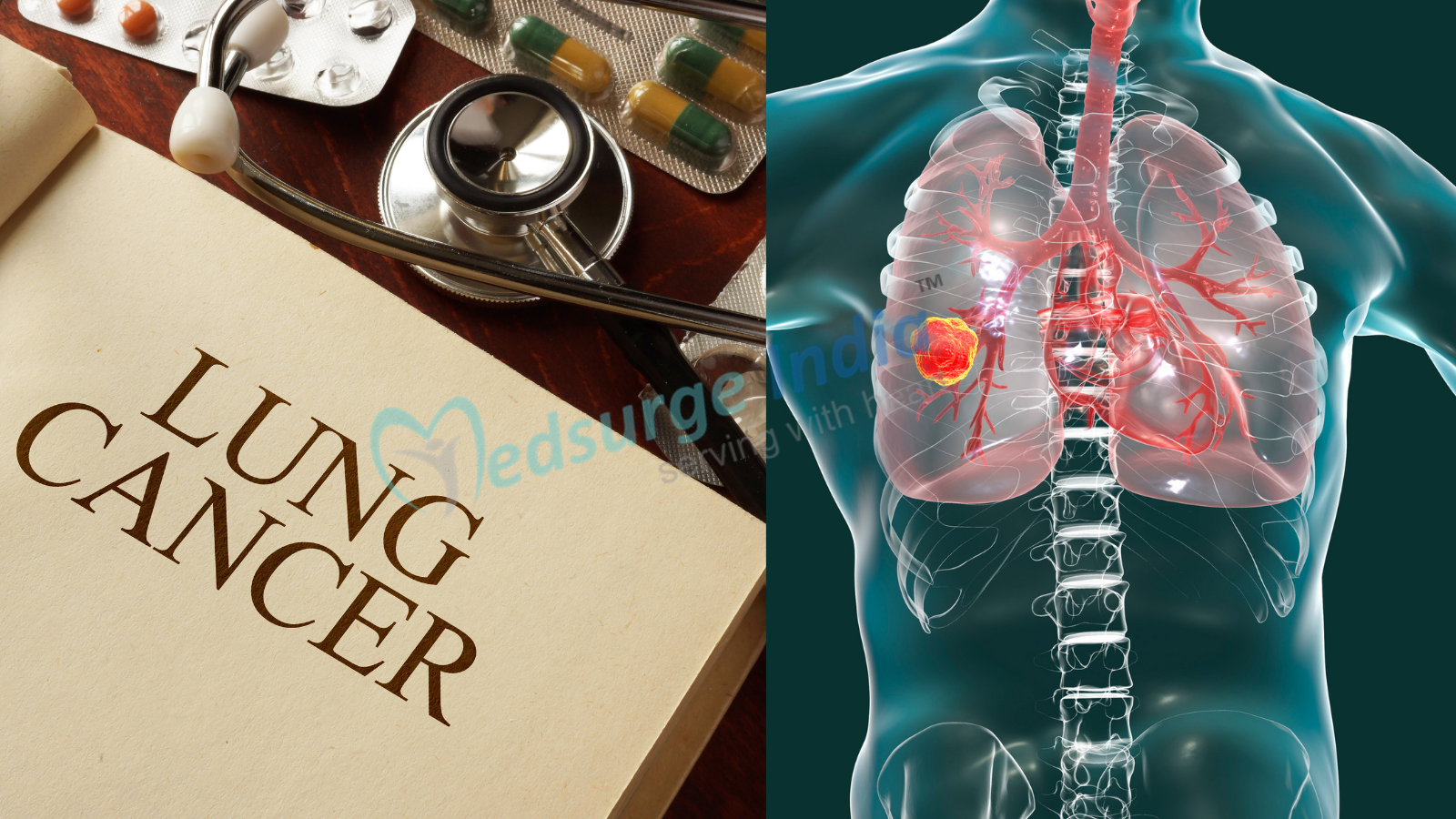 lung-cancer-treatment-cost-in-india-stage-4-lung-cancer-treatment