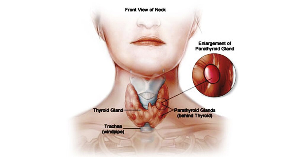 parathyroid cancer