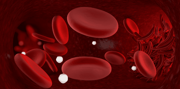 Pgd For Sickle Cell Disease Prevention 