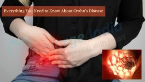 Crohn’s Disease