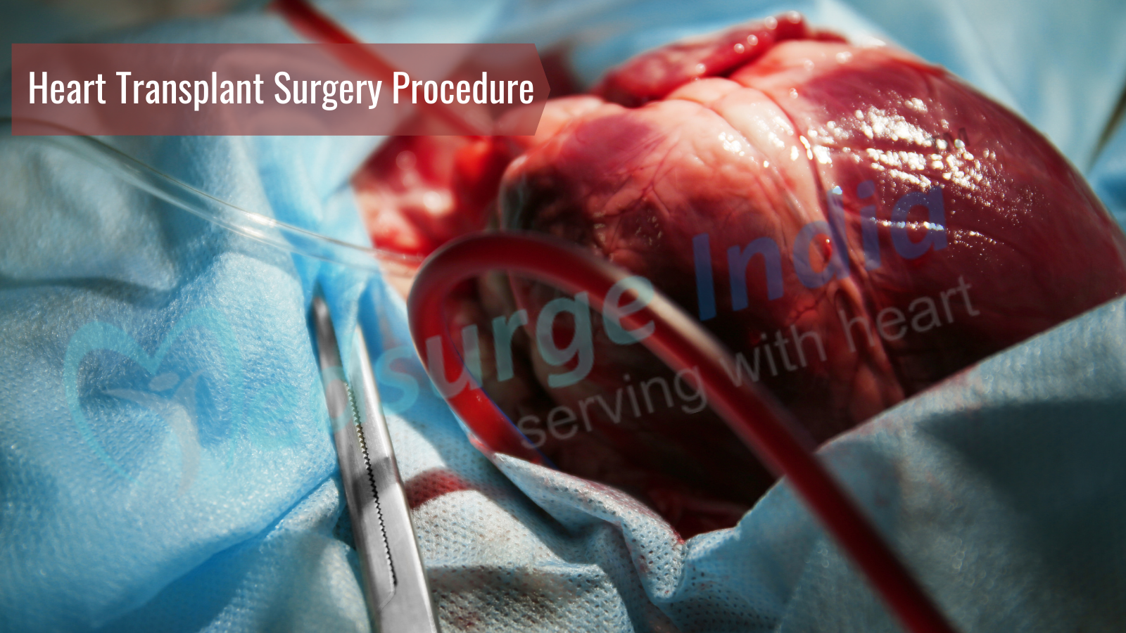 Heart Transplant Surgery – How To Prepare And What To Expect
