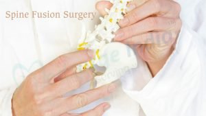 spine fusion surgery
