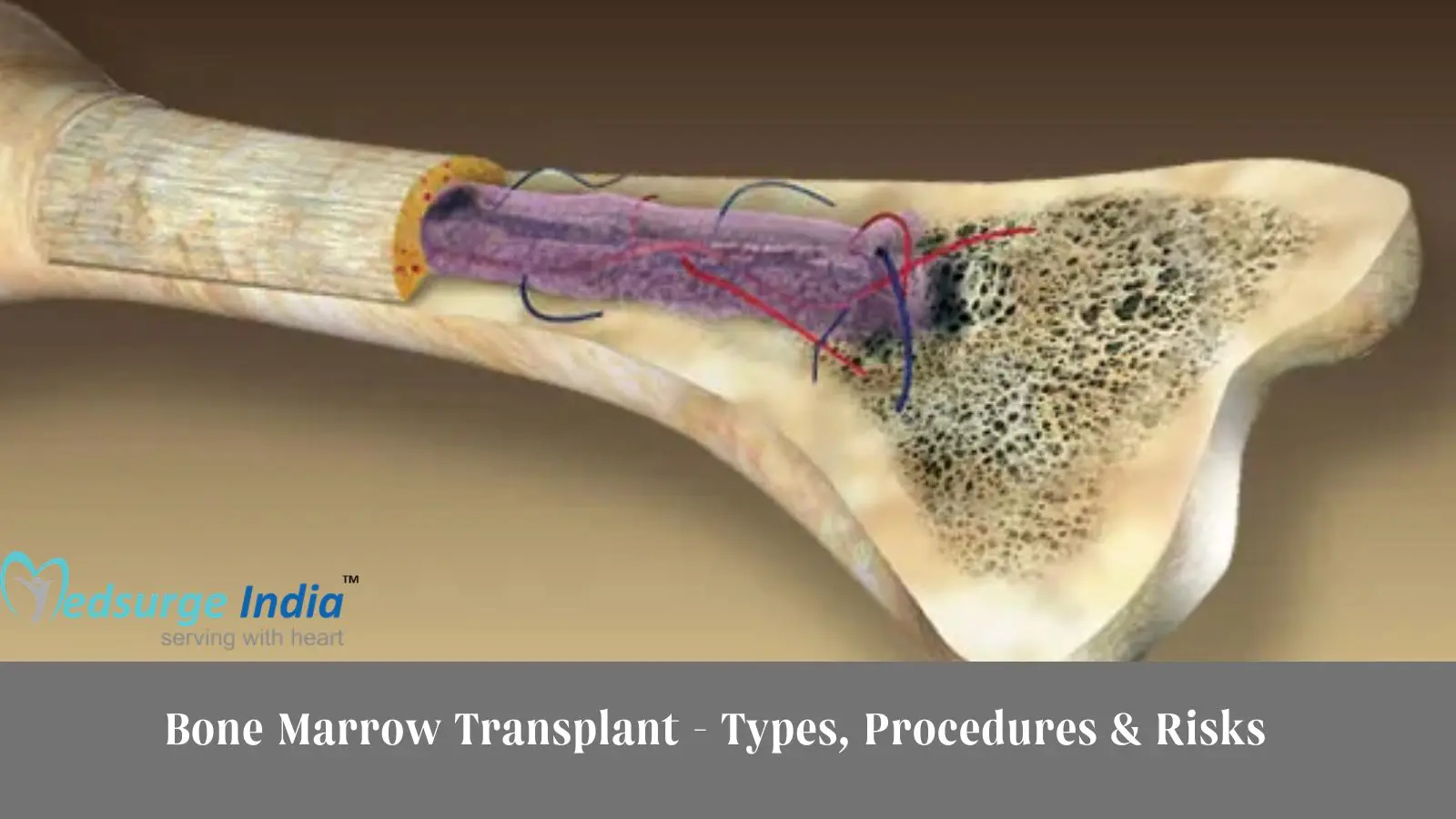 Bone Marrow Transplant – Types, Procedures & Risks
