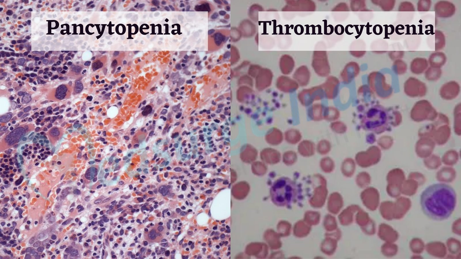 Pancytopenia-vs-Thrombocytopenia