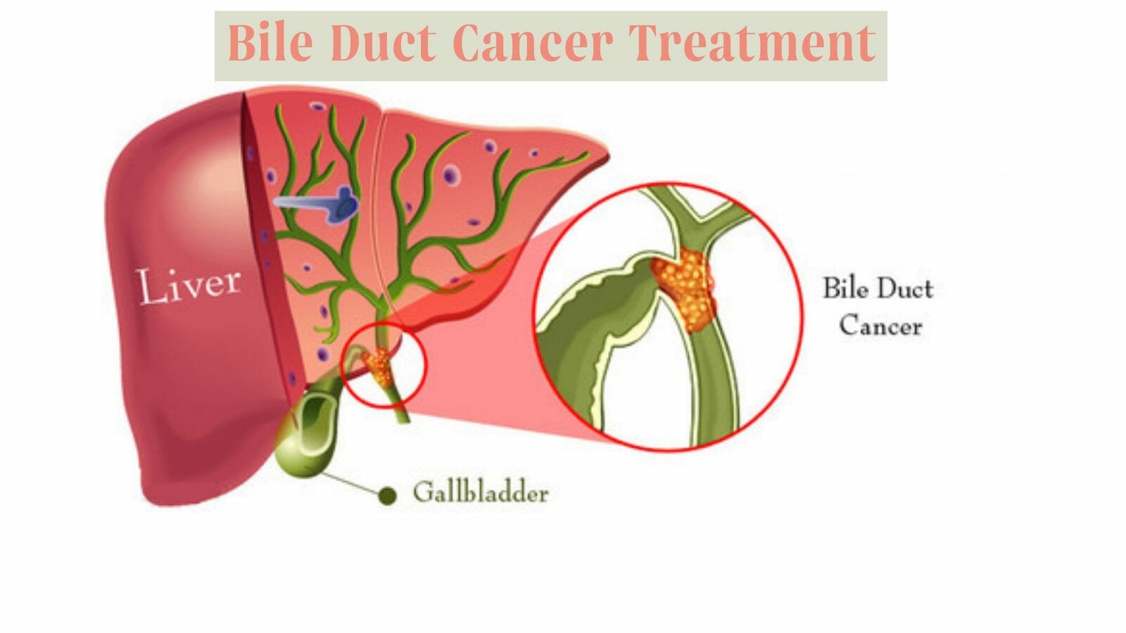 Bile Duct Cancer Treatment Cost in India