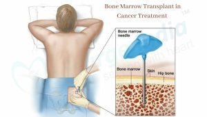 Bone Marrow Transplant in Cancer Treatment