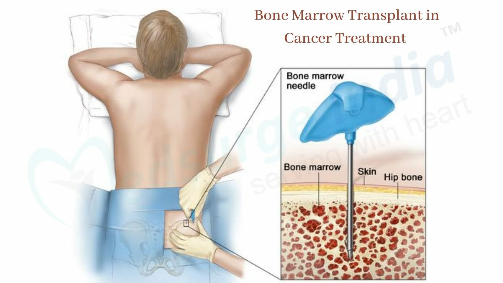 Role of Bone Marrow Transplant in Cancer Treatment