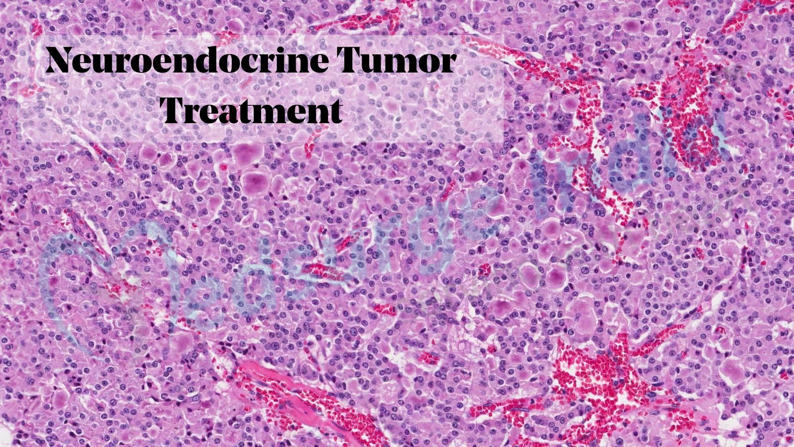 Neuroendocrine Tumor Treatment Cost In India Medsurge India