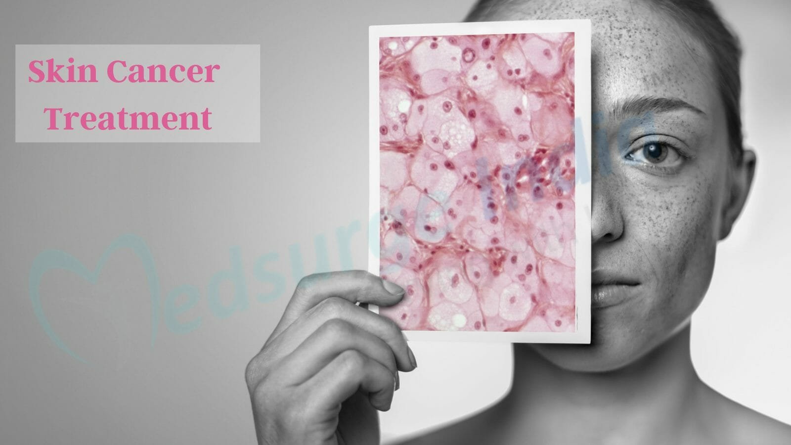 Skin Cancer Treatment Cost in India