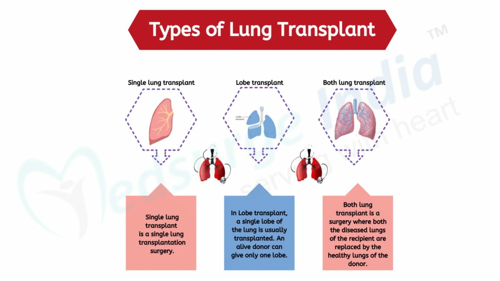 Types of Lung Transplant