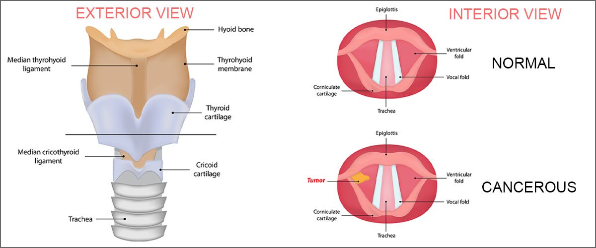 Coût du traitement du cancer du larynx en Inde | Medsurge Inde