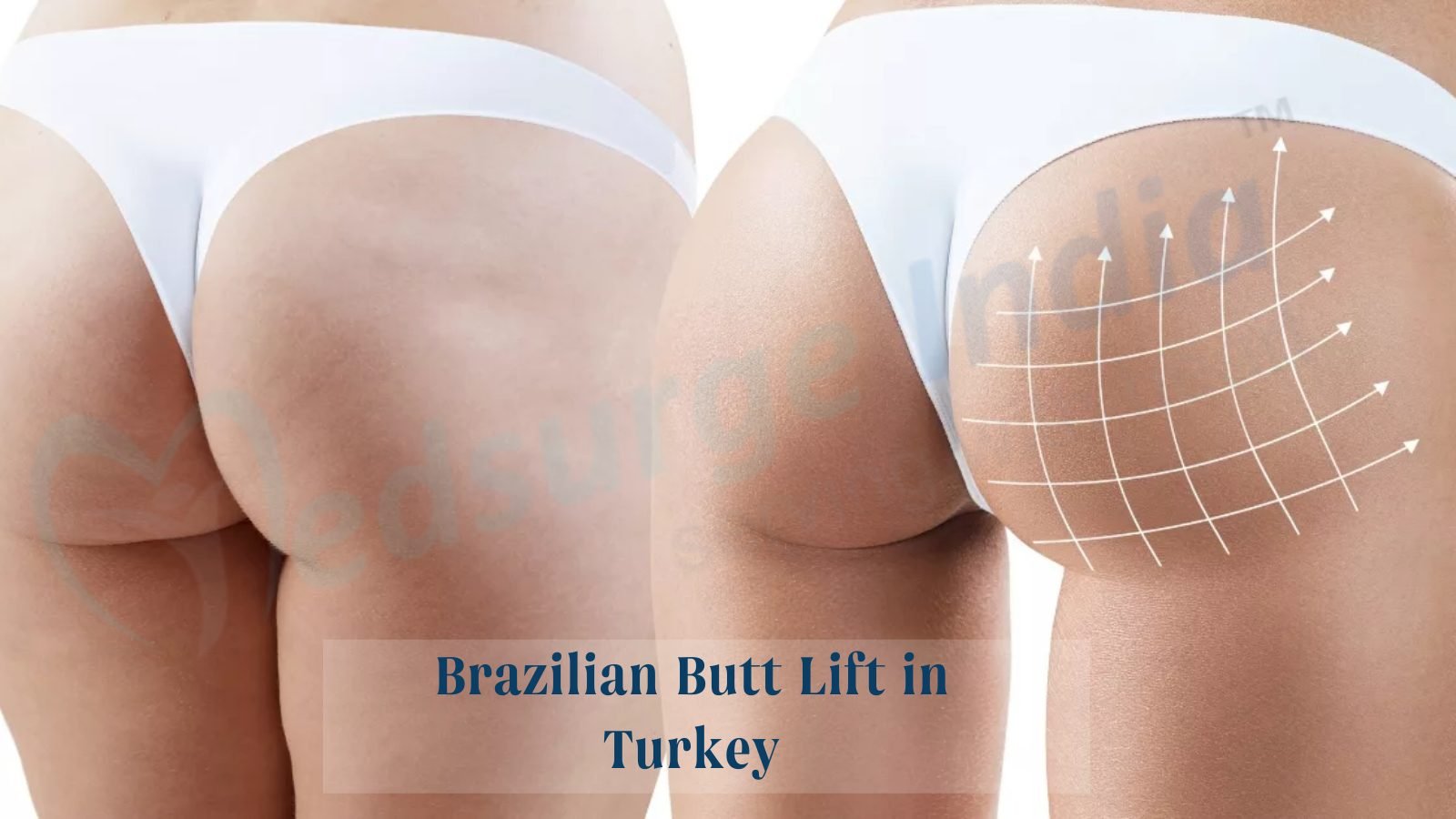 Brazilian Butt Turkey, BBL Cost in Istanbul