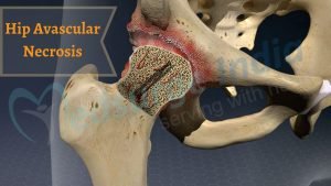 Hip Avascular Necrosis - Preservation & Replacement Hip Avascular Necrosis