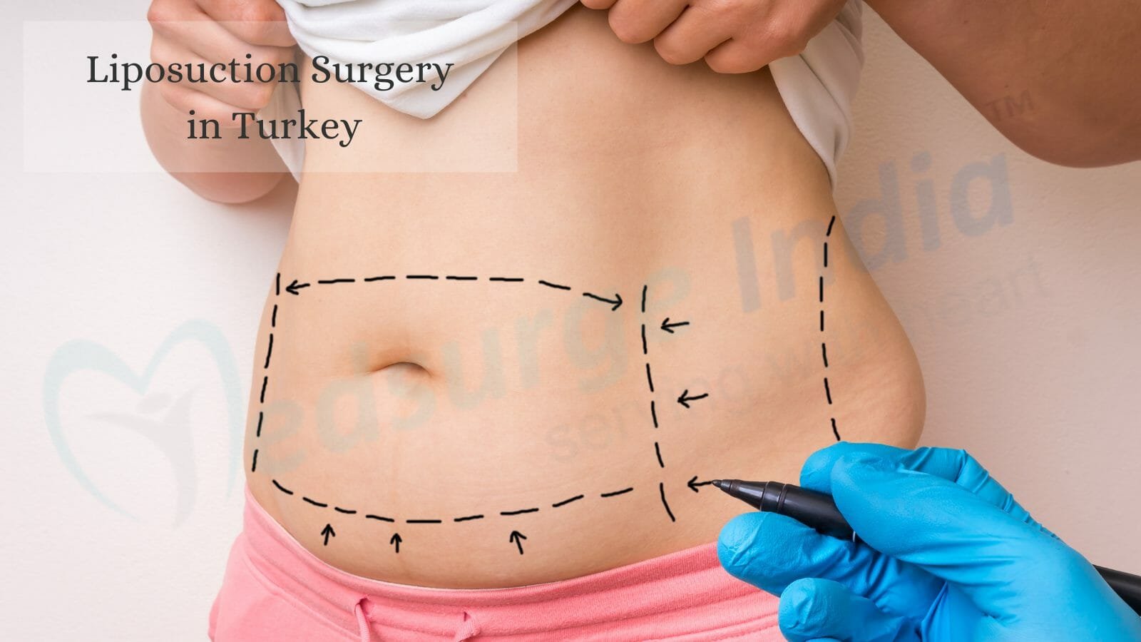 Liposuction Surgery Cost in Turkey